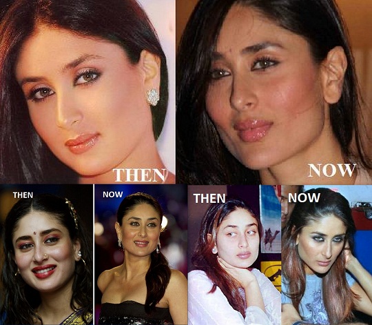 Kareena-kapoor-before-after-surgery-pics