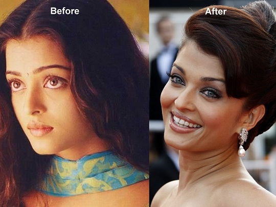 aishwarya-rai-before-after-surgery-pics