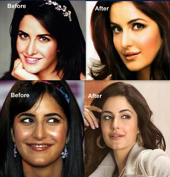 katrina-kaif-before-after-surgery-pics